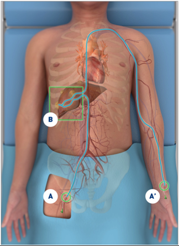 SIRT Treatment