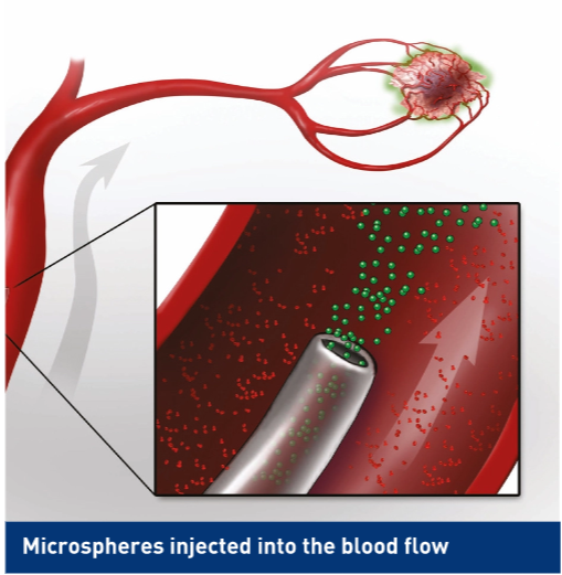 Microsheres injected